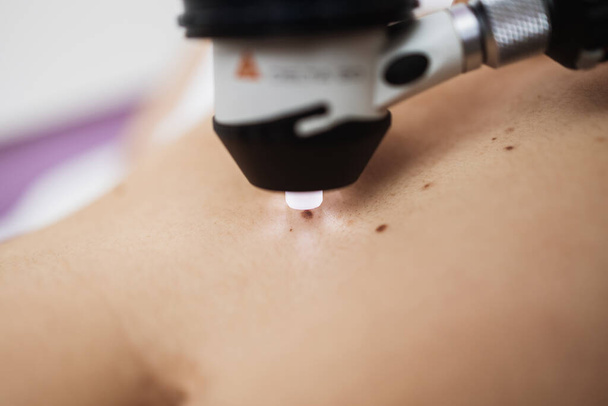 Close up shot of modern dermatology skin check up with digital deramatoscope. Dermoscopy microscope procedure and skin cancer prevention treatment.  - Foto, afbeelding
