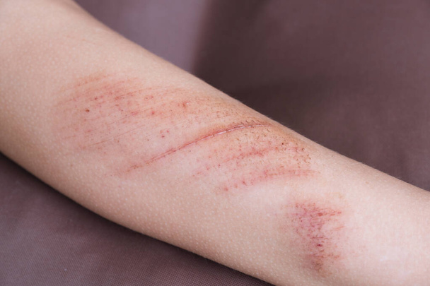 Heridas, arañazos y abrasiones en la piel de la pierna del niño. Lesiones infantiles. - Foto, Imagen