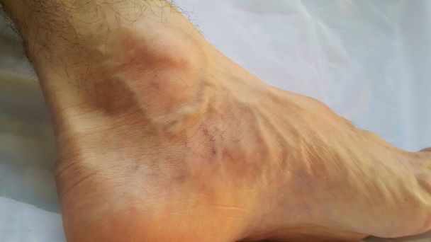 脚だ。静脈瘤だ。フェロボリズム。血栓性胆石炎。足のかかとには赤と青の毛細血管が見えます。静脈の血管の拡大から皮膚上のトレース. - 写真・画像