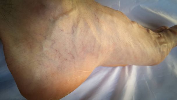 Jambe. Varices. Phléborisme. Thrombophlébite. Des capillaires rouges et bleus sont visibles sur le talon du pied. Une trace sur la peau de l'expansion des vaisseaux sanguins des veines. - Photo, image