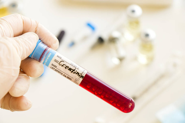 A closeup shot of a gloved hand holding a creatinine blood test sample in a lab - Фото, зображення