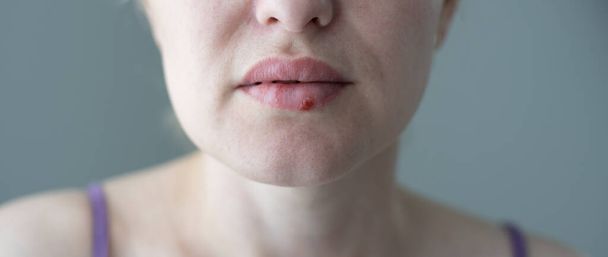La mujer con un virus herpes en los labios - Foto, Imagen