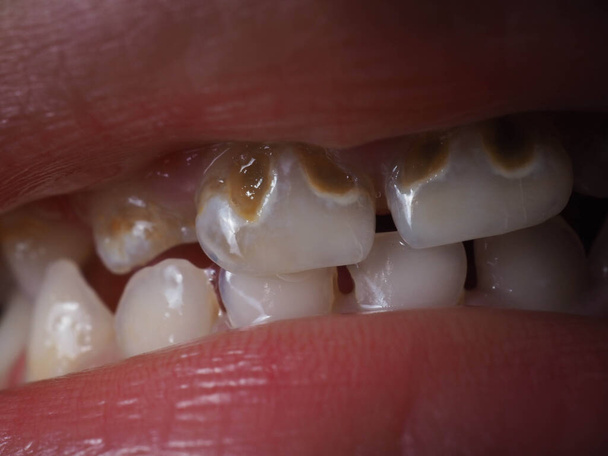 Pictures of kid's rotten teeth that usually caused by Poor dental hygiene, baby bottle, poor diet, etc - Photo, Image