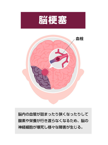 Types of human brain stroke vector illustration | Cerebral infarction - Vektör, Görsel
