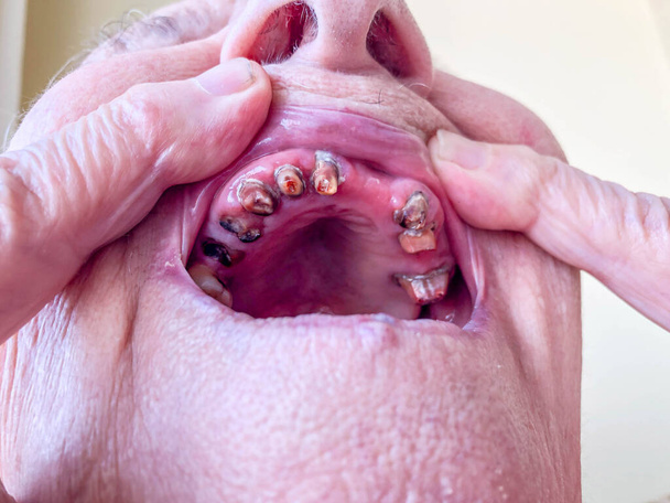 közelkép száj egy idős nő nagyon rossz fogak - Fotó, kép