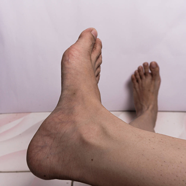 Várices en el pie derecho de una mujer adulta - Foto, Imagen