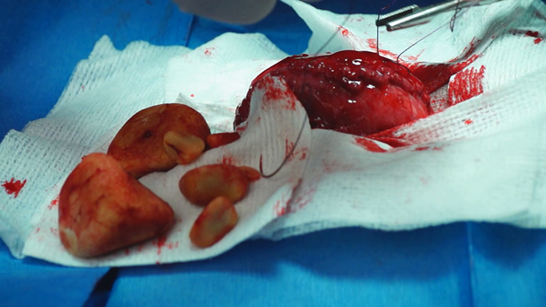 Veterinarian removing several large Bladder stones in a dog. - Footage, Video