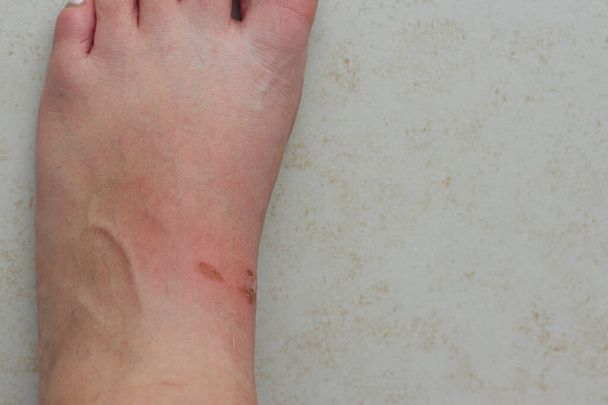 primo piano di un piede sinistro delle donne con ferite insanguinate causate da calli. Problema dopo aver indossato un nuovo sandalo in estate - Foto, immagini
