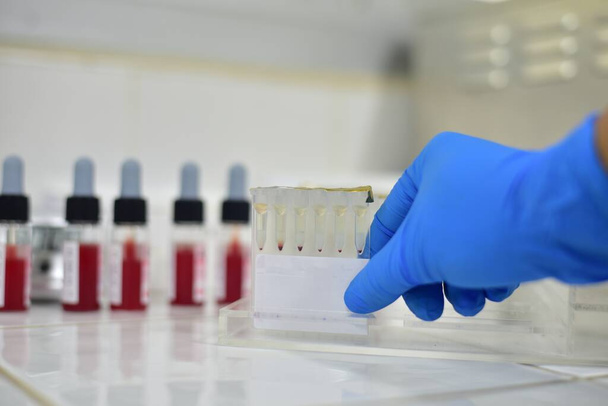 agglutination de colume de gel dans les tests de laboratoire de banque de sang. - Photo, image