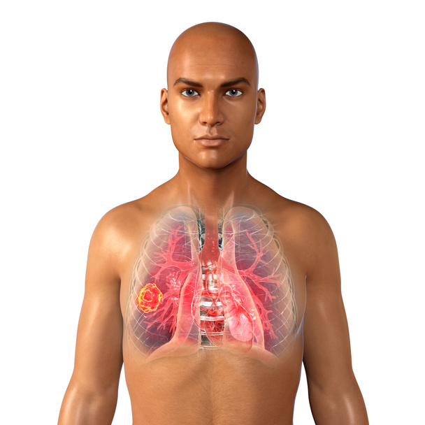 Mucormicosis pulmonar, una enfermedad pulmonar causada por hongos Mucor, también conocido como hongo negro y hongo amarillo, ilustración 3D. Complicación de Covid-19 - Foto, Imagen