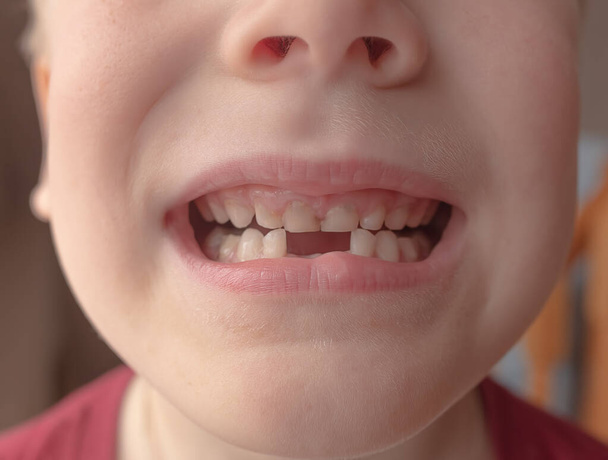 a criança perdeu dois dentes anteriores inferiores de leite. Conceito de higiene oral. close-up. - Foto, Imagem