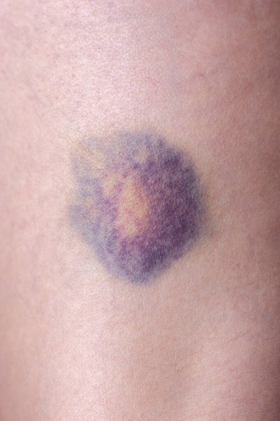 Multi-gekleurde ronde blauwe plek op de huid van het been. - Foto, afbeelding
