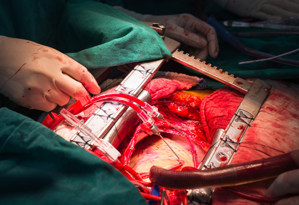 Пряма кардіоплегія крові через повітропровід
 - Фото, зображення