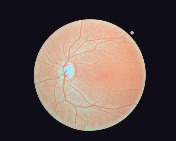 Obraz siatkówki prawego oka odizolowany na czarnym tle. Normalna ludzka siatkówka - Zdjęcie, obraz