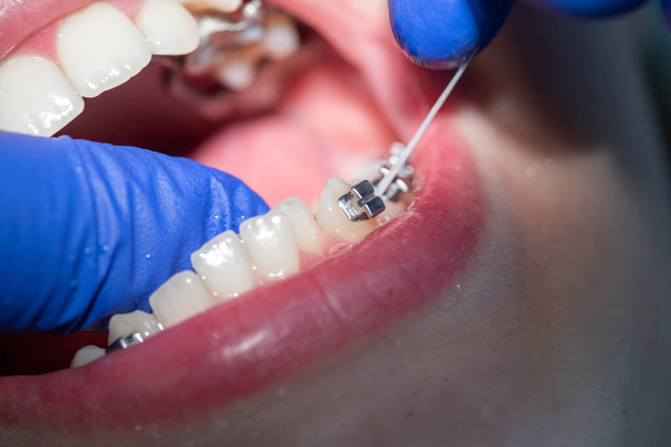 Detailní záběr zubů s dětskými rovnátky na zubaře na zubní klinice a umístění rovnátka na zuby - Fotografie, Obrázek
