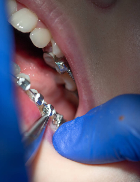 歯医者の予約で赤ちゃんのブレースで歯のクローズアップと歯の上にブレースを配置 - 写真・画像