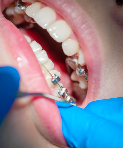Fogszabályzós fogsor közelkép egy fogorvosi rendelőben, fogszabályzóval a fogán. - Fotó, kép