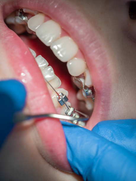 Крупный план зубов с детскими брекетами на приеме у стоматолога в стоматологической клинике и размещение брекетов на зубах - Фото, изображение