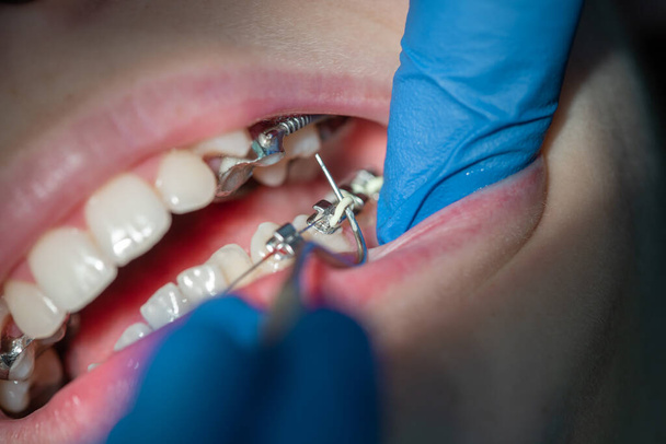 Diş hekiminde diş teli takılmış diş telleri takılmış ve diş telleri takılmış. - Fotoğraf, Görsel
