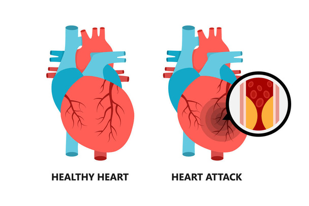 健康で不健康な心。アテローム性動脈硬化性プラークと心臓. - ベクター画像