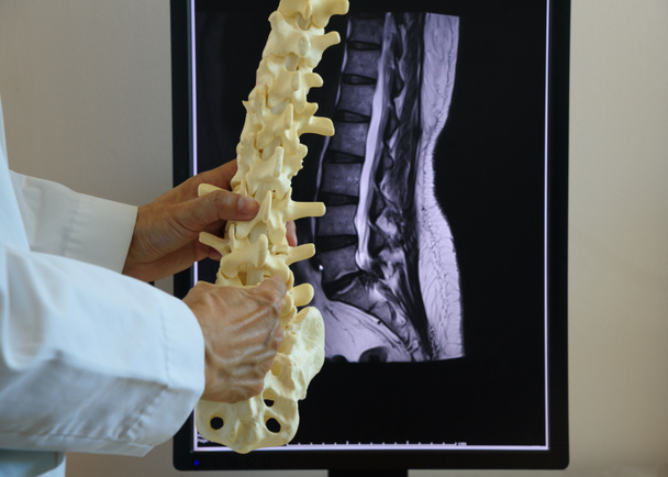 Γιατρός κρατώντας οσφυϊκή μοίρα σπονδυλικής στήλης μοντέλο μπροστά από οθόνη υπολογιστή MRI σπονδυλικής στήλης - Φωτογραφία, εικόνα