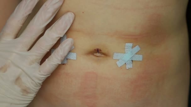 Inspectie van chirurgische hechtingen op de buik van het kind na een operatie op lies- en navelhernia. - Video