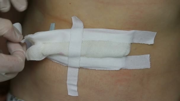 Bendaggio. Rimozione della benda di garza per il trattamento delle suture chirurgiche sull'addome del bambino dopo l'intervento chirurgico per ernie ombelicali e inguinali. - Filmati, video