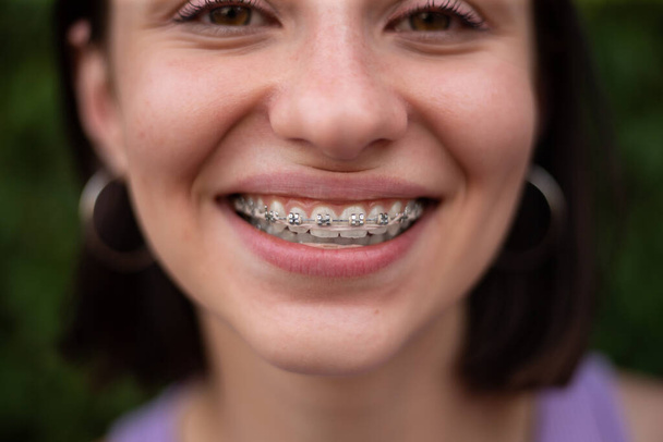 Молодая девушка с прической Боба и футболкой с куклой, улыбающаяся в металлических зубных скобках для коррекции укуса на зубах - Фото, изображение