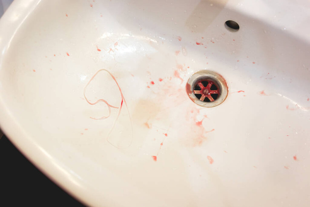 Λευκή λεκάνη πλύσης, υπολείμματα οδοντικού νήματος, κηλίδες αίματος από φθορίζουσες βλάβες στα ούλα. - Φωτογραφία, εικόνα