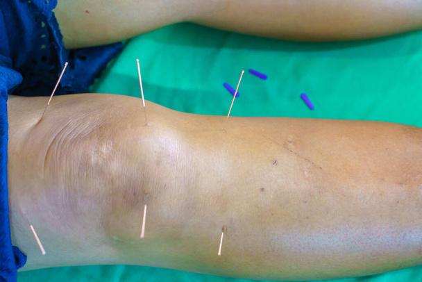 Primer plano de khee y pierna con aguja de acero durante el procedimiento de terapia de acupuntura. Medicina alternativa. - Foto, imagen