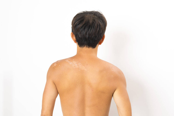peau sèche pelant en raison de la natation et de l'exposition au soleil sans appliquer de crème solaire - Photo, image