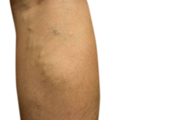venas varicosas en la pierna - Foto, imagen