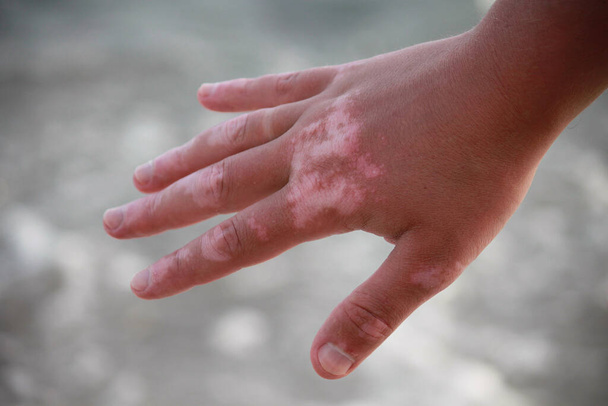 Vitiligo on the hand on the sea background. - Photo, Image
