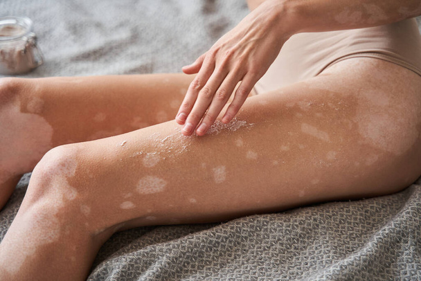 Woman with vitiligo skin sitting at the bed and applying moisturizer at her legs - Valokuva, kuva