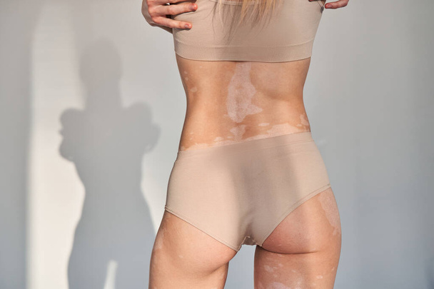 Žena s vitiligovou poruchou se stará o svou kůži, zatímco stojí ve studiu - Fotografie, Obrázek