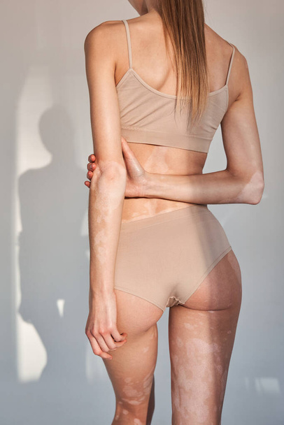 Gorgeous naked woman showing nude back with vitiligo affected skin - Foto, Imagem