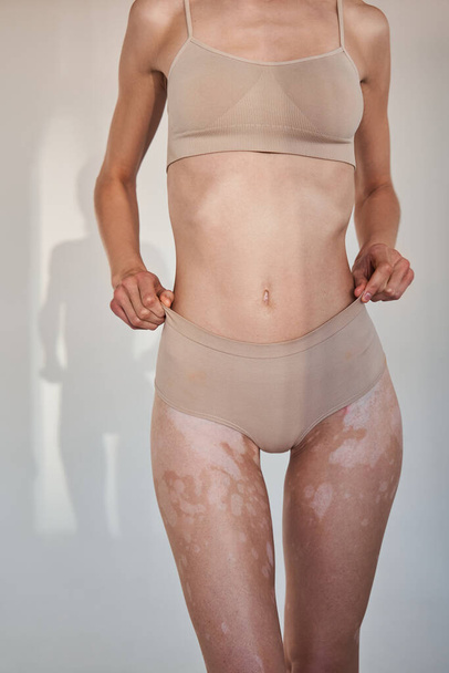 Naked woman showing nude body with vitiligo affected skin - Foto, afbeelding
