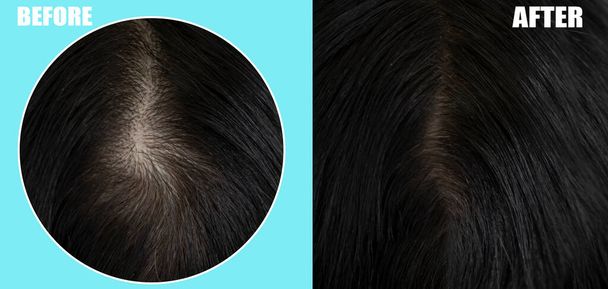 Haarausfall bei Frauen vor und nach der Behandlung - Foto, Bild