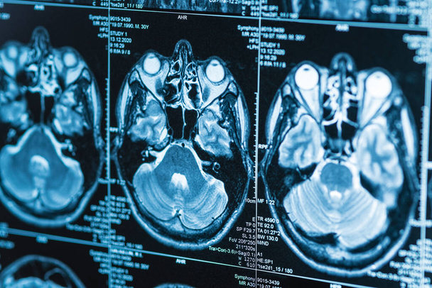 Serie von MRI-Bildern des Gehirns, Diagnostik, Nahaufnahme - Foto, Bild