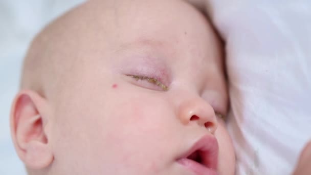 κρεβάτι μωρό πορτρέτο με τα μάτια με επιπεφυκίτιδα κρούστα ροζ μάτι σε νεογέννητο γκρο πλαν άποψη - Πλάνα, βίντεο