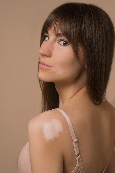 Uzun saçlı, bej iç çamaşırlı, vitiligolu genç bir kadın. - Fotoğraf, Görsel