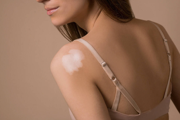 Een jonge langharige vrouw in beige lingerie met vitiligo - Foto, afbeelding