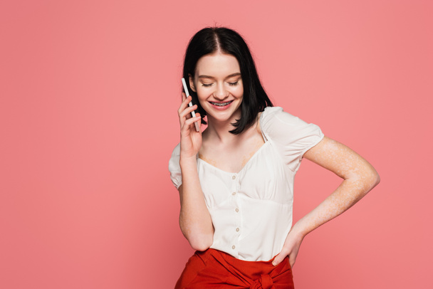 Cheerful woman with vitiligo talking on smartphone isolated on pink  - Foto, Imagem