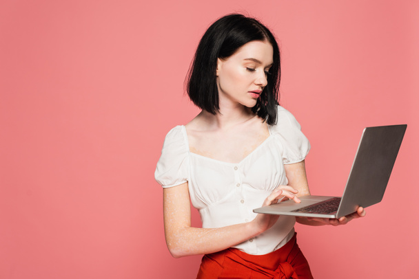 Young freelancer with vitiligo using laptop isolated on pink  - Foto, afbeelding