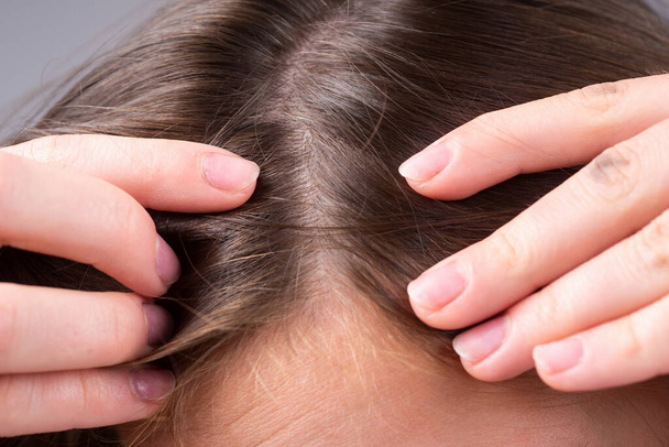 Close up of woman examining her scalp and hair, hair loss on hairline or dry scalp problem. - Foto, imagen