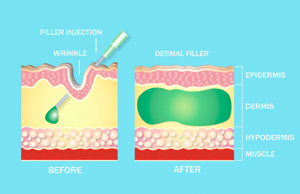 Injectable cosmetic filler or dermal fillers. Before and after. Lifting concept - 写真・画像