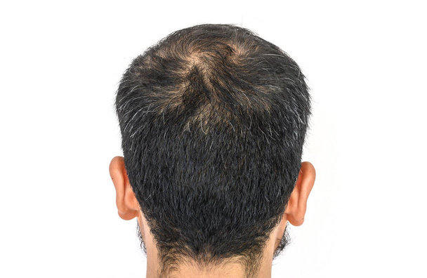 Vista posterior de la cabeza de los hombres con el pelo delgado y el pelo gris creciendo. Conceptual del problema del cabello en la cabeza de los hombres. - Foto, Imagen