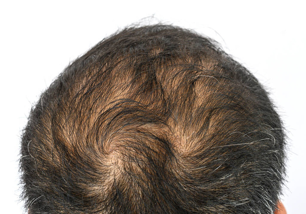 Вид зверху чоловіча голова з тонким волоссям і шлюхами волосся. Шторм волосся це пляма волосся, що росте в круговому напрямку навколо видимої центральної точки
. - Фото, зображення