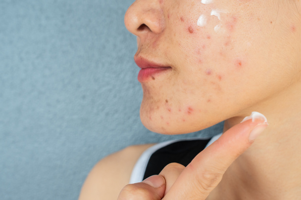 Vystřižený záběr ženy s akné zánět (Papule a Pustule) na tváři a ona nanáší akné krém na obličej k léčbě. Konceptuální problémy na ženské kůži. - Fotografie, Obrázek