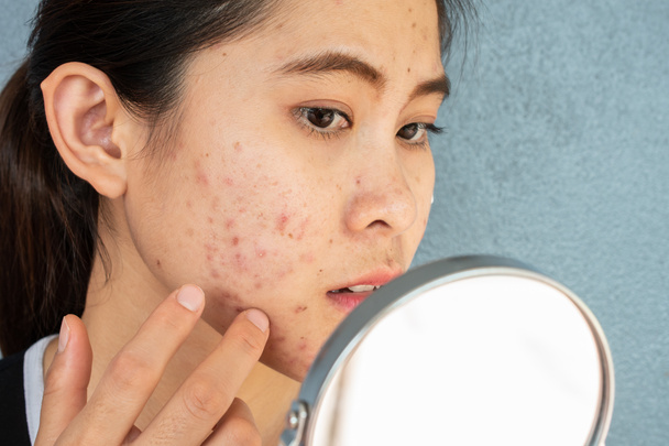Retrato de mujer asiática preocuparse por su cara cuando vio el problema de la inflamación del acné y la cicatriz por el mini espejo. Foto conceptual de acné y piel problemática en la cara femenina. - Foto, Imagen